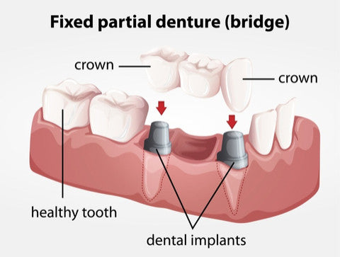 Illustration of a dental bridge