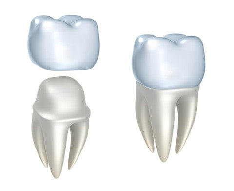 Illustration of a dental crown