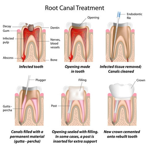Illustration of root canal treatment